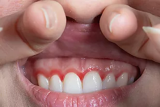 Gingivitis (inflamació i sagnat) - Quan et pot ajudar el tractament de les genives?
