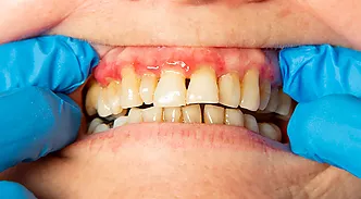 Inflor / possible infecció - Casos d’urgència més habituals