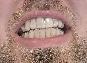 Ortodòncia invisible Invisalign - Quan et pot ajudar l’ortodòncia?