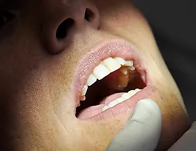 Carilles dentals - Quan et pot ajudar l’estètica i la higiene bucodental?