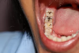 Càries en infants i adolescents - Quan et pot ajudar l’odontologia i l’ortodòncia pediàtrica?