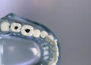 Càries i empastaments - Quan et pot ajudar l’odontologia general?