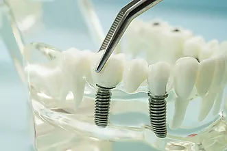 Pròtesis dentals - Quan et poden ajudar els implants i les pròtesis?